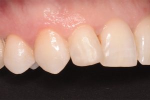 tooth repaired after bonded filling