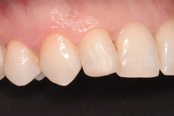 tooth repaired after bonded filling