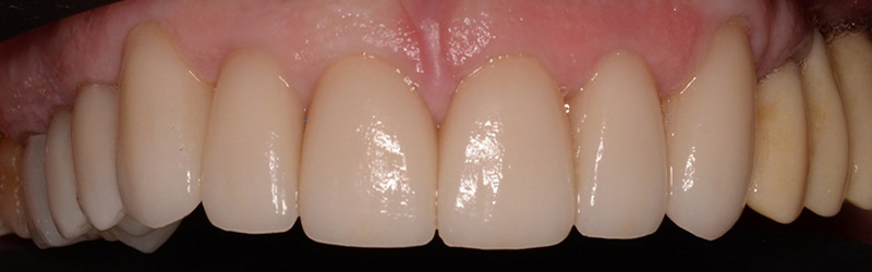 healthy teeth after dental crowns