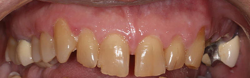 crooked, misaligned teeth before treatment