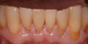 exposed dentin and recessed gums