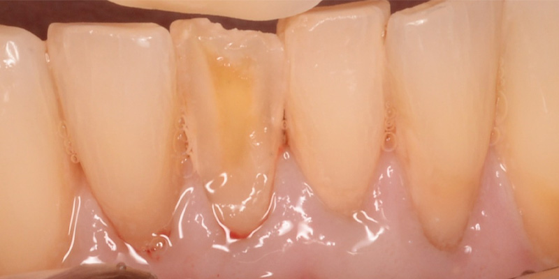 exposed dentin on lower teeth