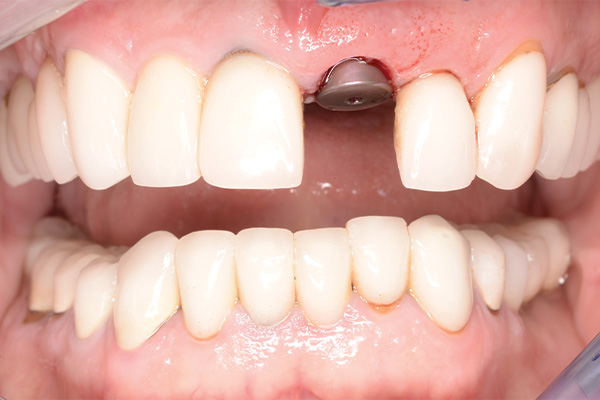 dental implant for missing front tooth