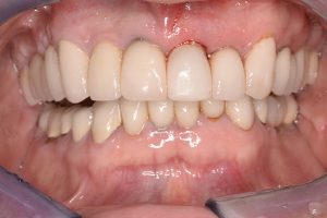 missing front incisor replaced with implant