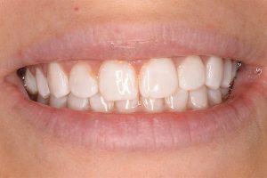 after teeth whitening