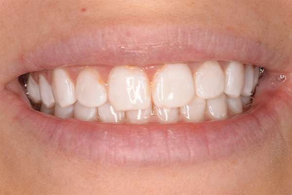 after teeth whitening