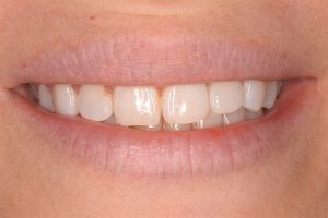 before teeth whitening