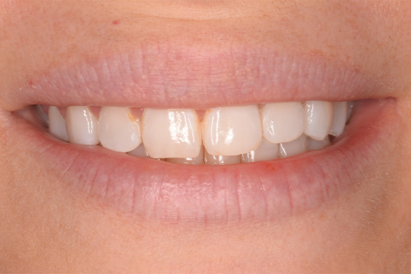 before teeth whitening