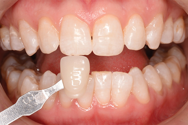 teeth whitening case 1082