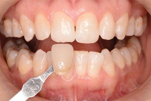 after teeth whitening