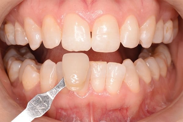 after teeth whitening