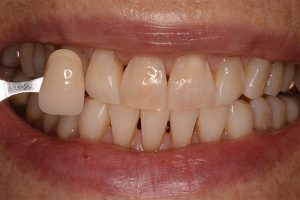 whiter teeth after treatment