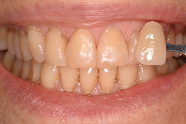 whitening for yellow teeth