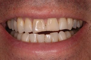 large gap between upper and lower row of teeth