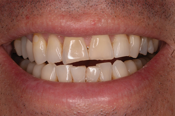 large gap between upper and lower row of teeth
