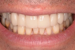 veneers on upper teeth row