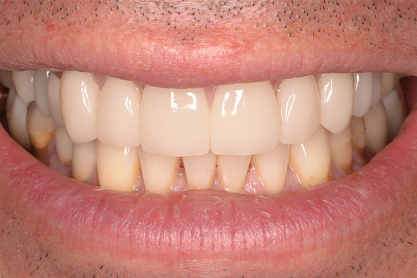 veneers on upper teeth row