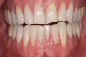 gaps between upper and lower teeth before veneers