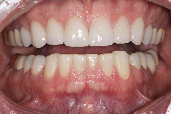 aligned teeth after veneers