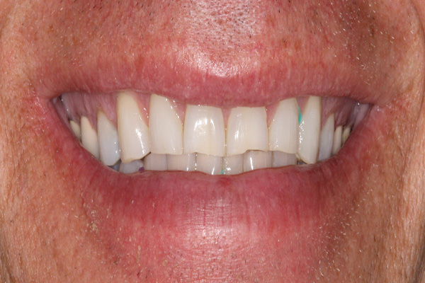 sharp, uneven teeth before veneers