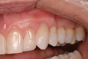 bonded filling restores tooth