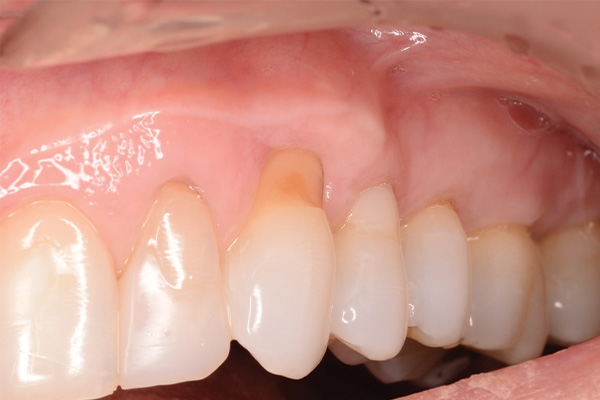 root of tooth exposed