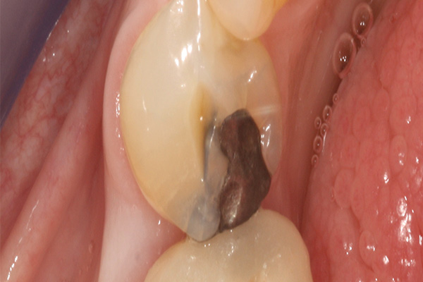 patient's teeth before bonded filling