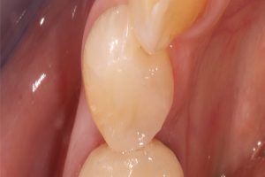 patient's teeth after bonded filling