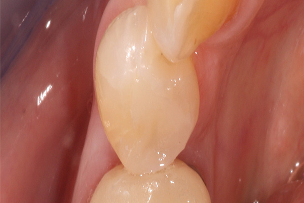 patient's teeth after bonded filling