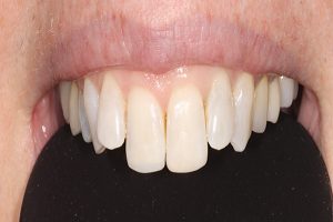 after bonded fillings on upper front teeth