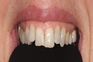 uneven teeth before bonded fillings