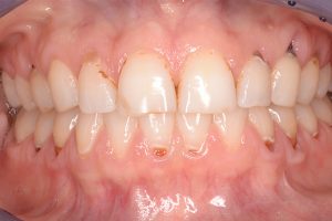 before dental bonded fillings