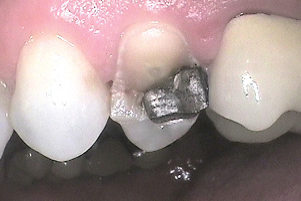 before dental crown