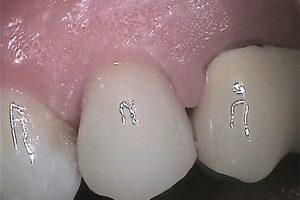after dental crown
