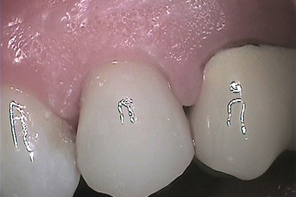 after dental crown