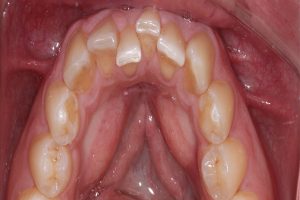 crooked teeth before Invasalign