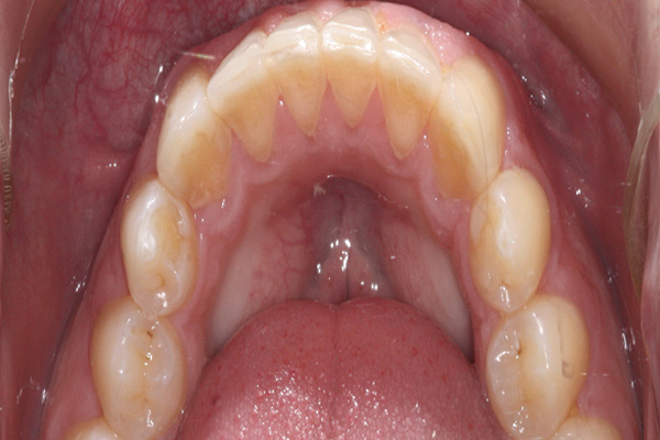straight teeth after Invasalign