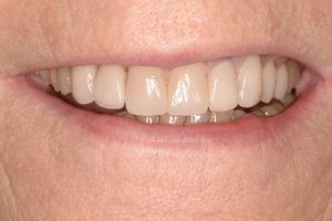 white, shining teeth after veneers