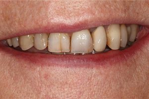 dark, stained teeth before veneers
